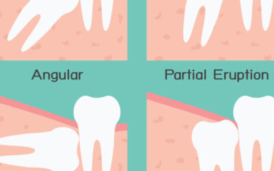 How to Fix Impacted Teeth