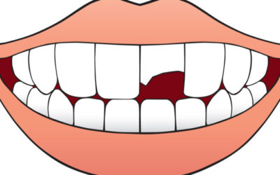 5 Treatment Options for a Broken Tooth