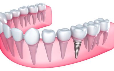 “Can I get dental implants years after extraction?” and other FAQs
