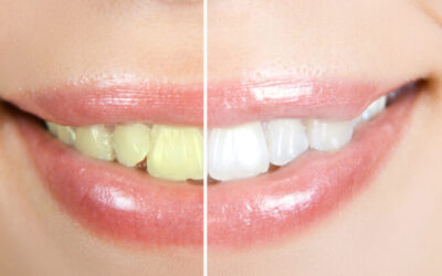 Cosmetic Dentistry: The Solution for Aesthetic Dental Problems