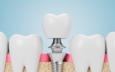 Lombard Dentist Explains the Benefits of Dental Implants