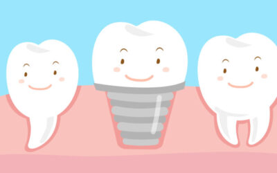 Considering dental implants? Check out these 5 important facts before making your final decision!