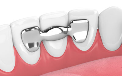 What type of dental bridge is right for me?