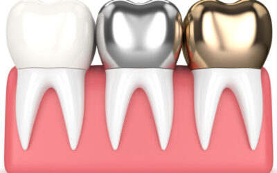 Everything You Need to Know Before Getting A Dental Crown