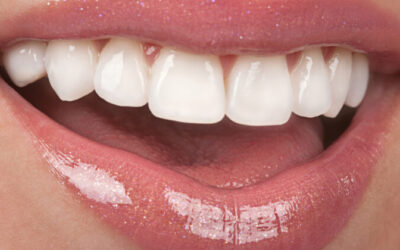 Are porcelain veneers safe?