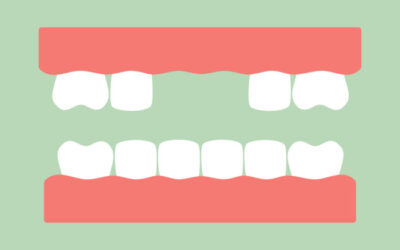 Dental Bridge: An Effective Solution for Missing Teeth