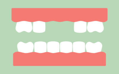 Dental Bridge: An Effective Solution for Missing Teeth