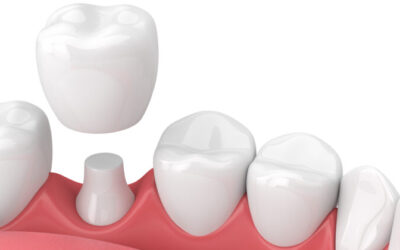 Dental Crowns: Which type do you need?