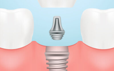 Dental Implants: The Good, The Bad, and The Best