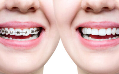 Invisalign® Clear Aligners vs Traditional Metal Braces: Which is best for your smile?