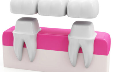 Common Myths and Facts About Dental Bridges