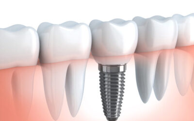 The Pros and Cons of Dental Implants