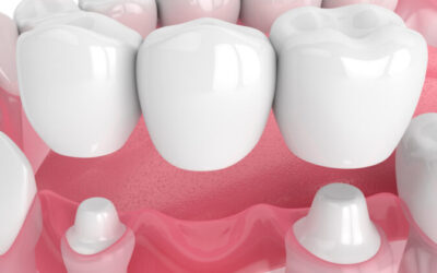 Restore Your Smile with a Dental Bridge