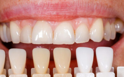 Four Important Questions to Ask Before Getting Dental Veneers