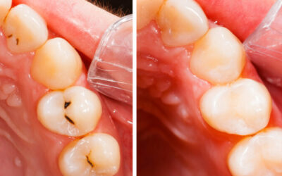 “How long do composite fillings last?” and Other FAQs