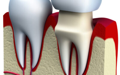 Four Ways to Protect New Dental Crowns