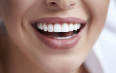 How should I prepare for professional teeth whitening?