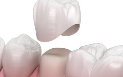What Do Dental Crowns Do?