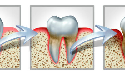 Why Is a Dental Cleaning So Important?