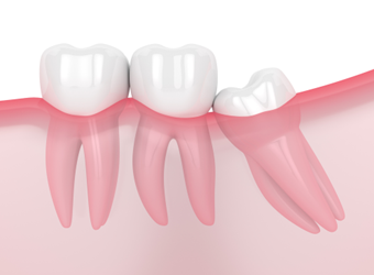 5 Things to Know Before Wisdom Tooth Removal