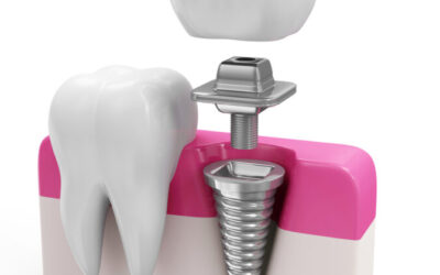 You Don’t Need a Periodontist: Implants Offered Here!