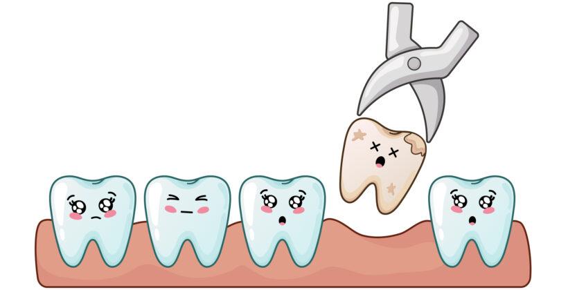 vectors tooth extraction