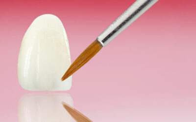 Comparison: Porcelain Veneers vs Cosmetic Dental Crowns