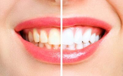 25 Interesting Facts About Teeth Whitening