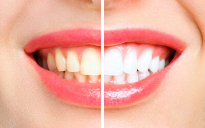 Stains on Teeth: Why They Appear and How to Get Rid of Them