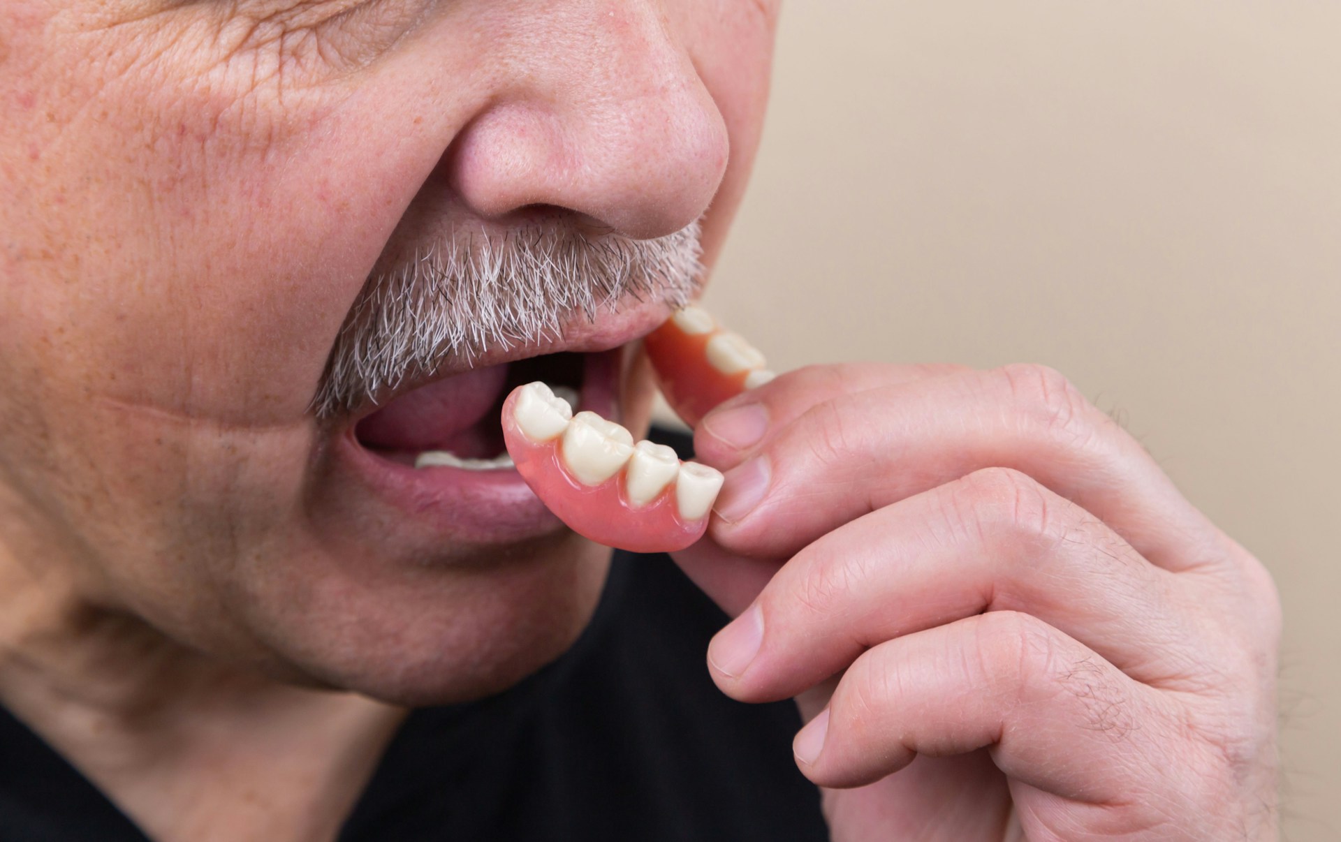 older man with missing teeth putting in his dentures