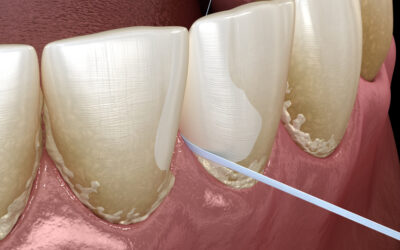 How Is Tartar Formed? Understanding the Sticky Truth Behind Plaque Buildup