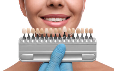 Your Top Questions About Dental Veneers Answered by a Lombard Dentist