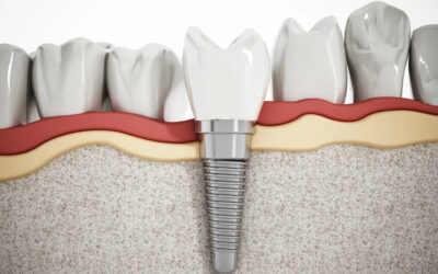 Why Dental Implants Are the Closest Thing to Natural Teeth