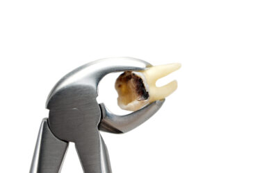 Pulled Tooth Care: Do’s and Don’ts for a Speedy Recovery