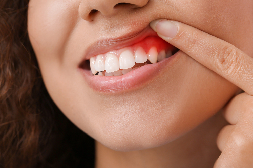 close up of woman raising her lip to show her red, inflamed gums