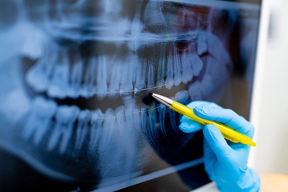 x-ray of teeth, dentist pointing with a pen to front tooth
