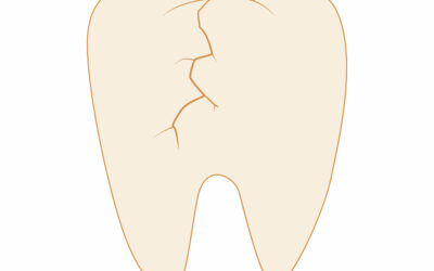 What Are the Signs That I Might Need a Dental Filling or Crown?