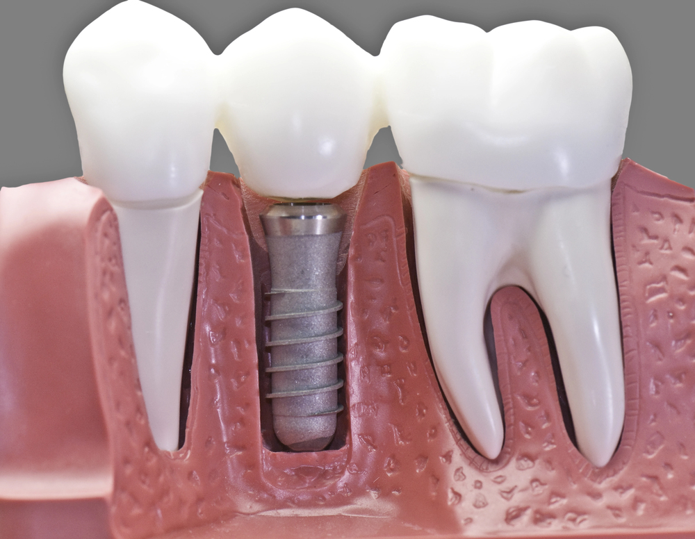 model of dental implant bridge