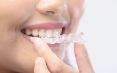 Invisalign® Attachments: What Are They and Why Are They Needed?