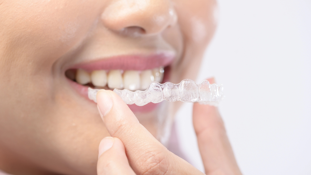 close up of woman placing invisalign aligner in her mouth