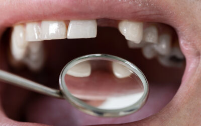 Missing Teeth? Here’s Why You Shouldn’t Wait to Replace Them