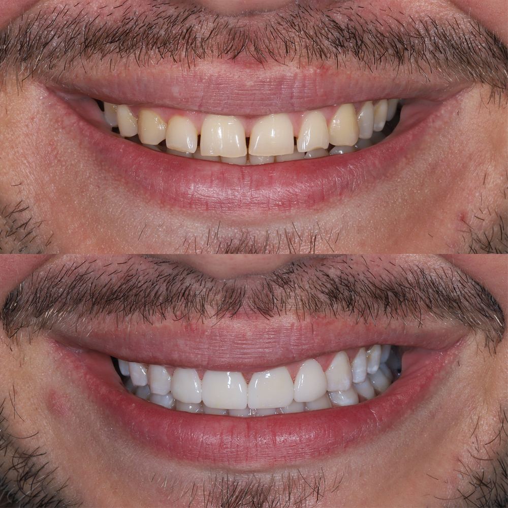 mans smile before and after veneers