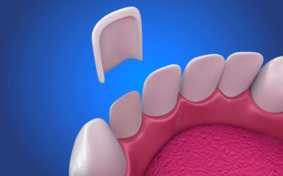 Can You Get Veneers with Gum Disease? What You Need to Know Before Treatment